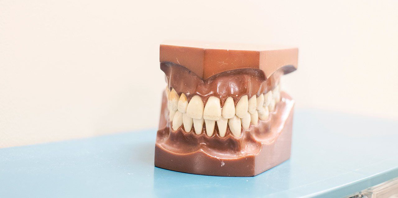 como-detectar-el-bruxismo-1 molde de prótesis dental